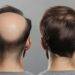 Men’s Hair Replacement Systems and Accessibility Resources